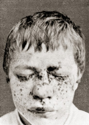 Blepharospasmus