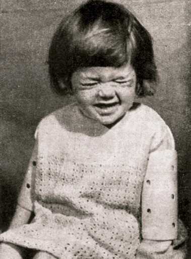 Blepharospasmus