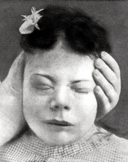 Blepharospasmus