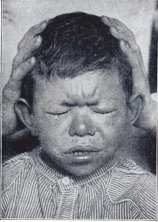 Kind mit Augenlidverschluss