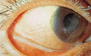 Generalized Xerophthalmia